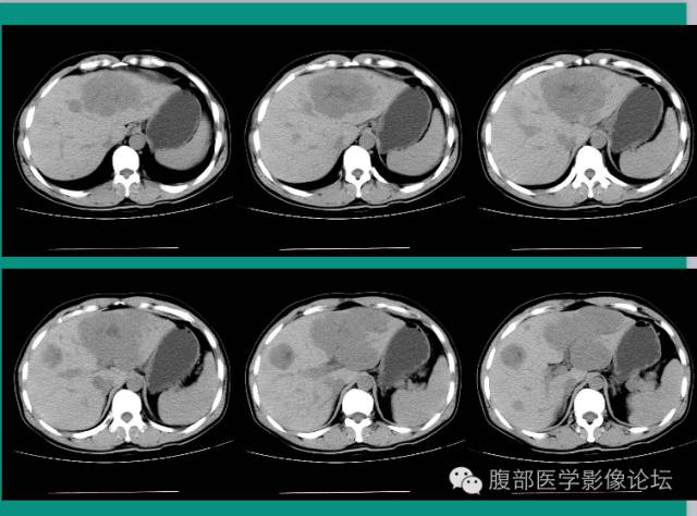 【病例】肝脏神经内分泌肿瘤NET一例CT影像表现 【病例】肝脏神经内分泌肿瘤NET一例CT影像表现