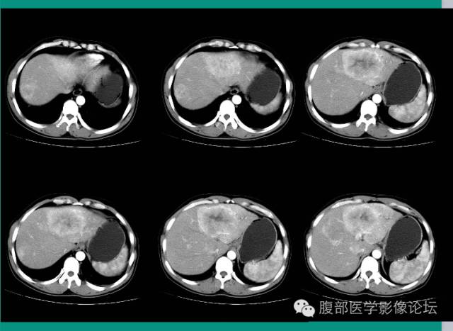 【病例】肝脏神经内分泌肿瘤NET一例CT影像表现 【病例】肝脏神经内分泌肿瘤NET一例CT影像表现