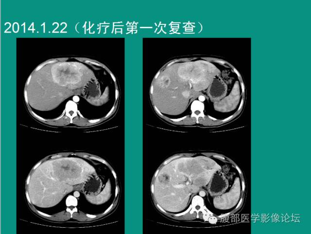 【病例】肝脏神经内分泌肿瘤NET一例CT影像表现 【病例】肝脏神经内分泌肿瘤NET一例CT影像表现