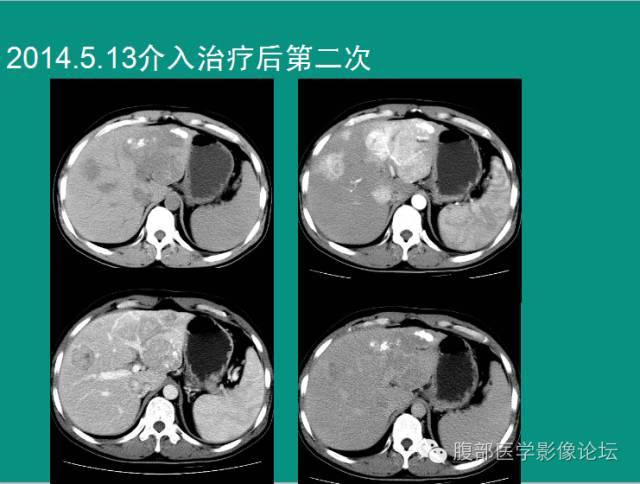 【病例】肝脏神经内分泌肿瘤NET一例CT影像表现 【病例】肝脏神经内分泌肿瘤NET一例CT影像表现