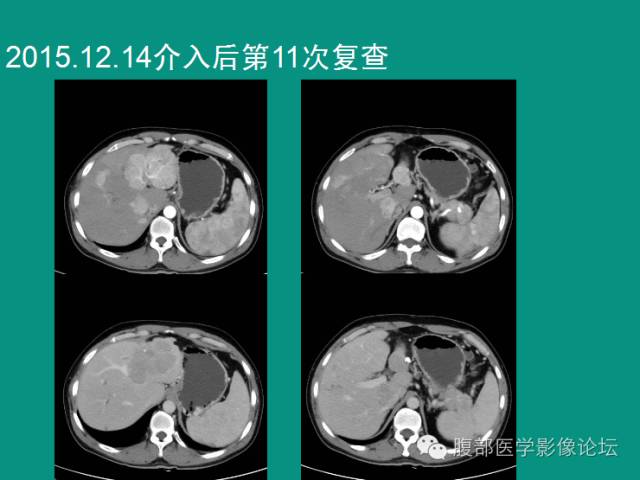 【病例】肝脏神经内分泌肿瘤NET一例CT影像表现 【病例】肝脏神经内分泌肿瘤NET一例CT影像表现