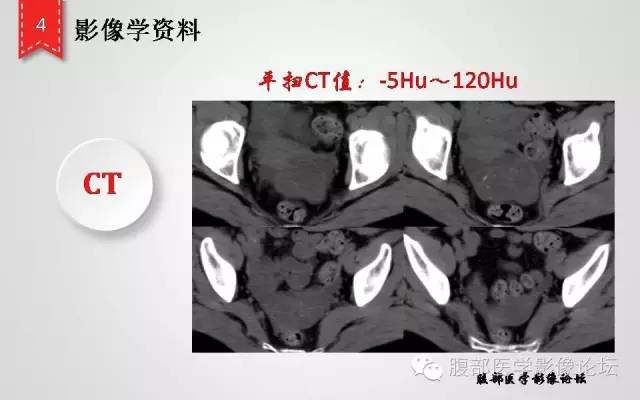 【病例】卵巢甲状腺肿1例CT及MR影像表现