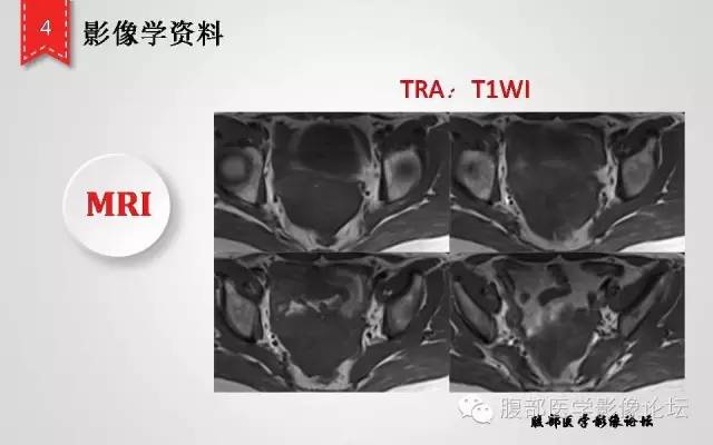 【病例】卵巢甲状腺肿1例CT及MR影像表现