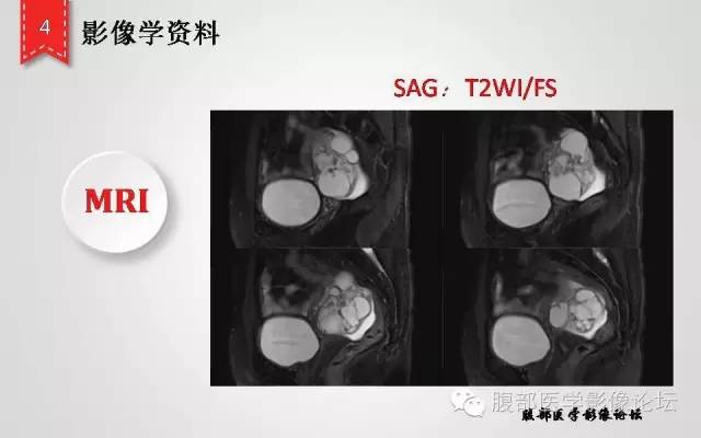 【病例】卵巢甲状腺肿1例CT及MR影像表现