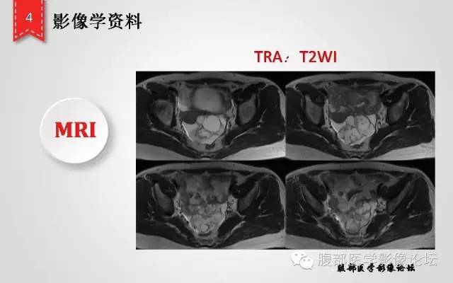 【病例】卵巢甲状腺肿1例CT及MR影像表现