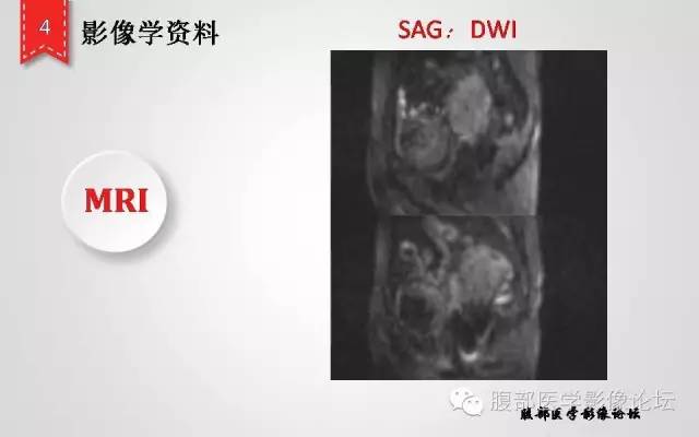 【病例】卵巢甲状腺肿1例CT及MR影像表现
