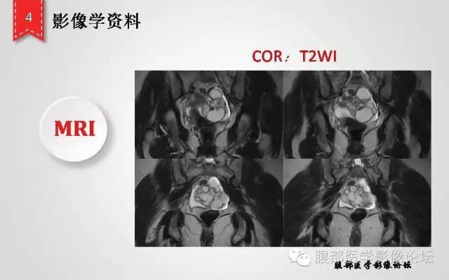 【病例】卵巢甲状腺肿1例CT及MR影像表现