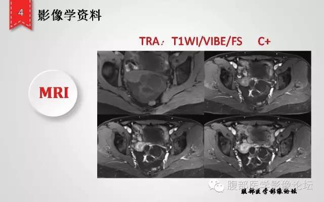 【病例】卵巢甲状腺肿1例CT及MR影像表现