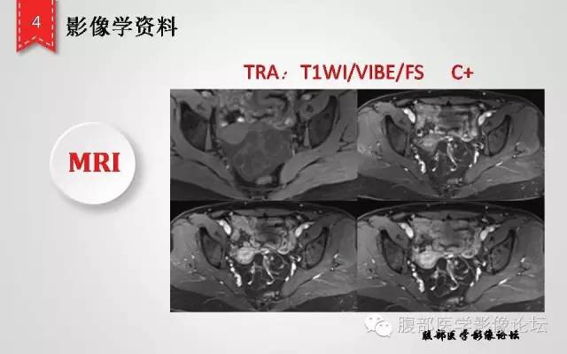 【病例】卵巢甲状腺肿1例CT及MR影像表现