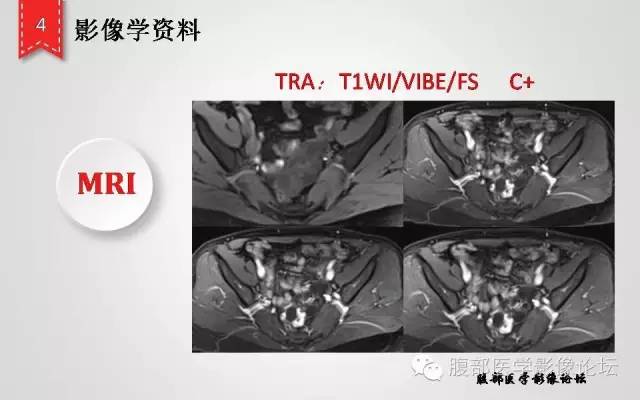 【病例】卵巢甲状腺肿1例CT及MR影像表现