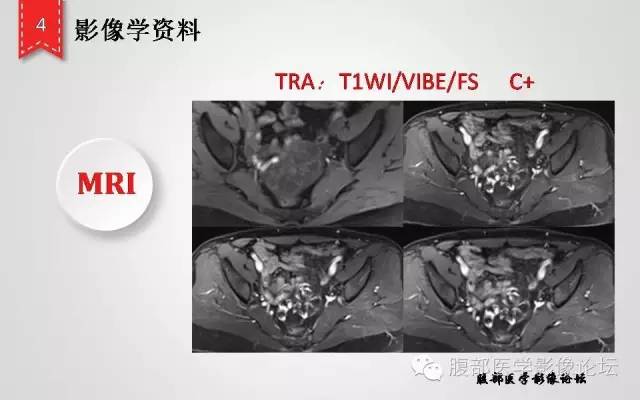 【病例】卵巢甲状腺肿1例CT及MR影像表现