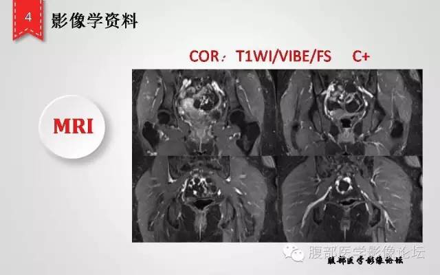 【病例】卵巢甲状腺肿1例CT及MR影像表现