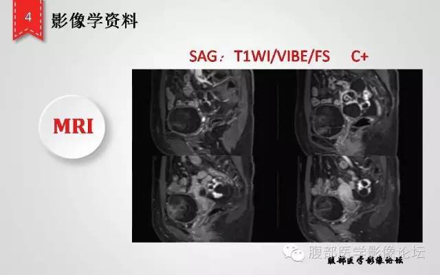 【病例】卵巢甲状腺肿1例CT及MR影像表现