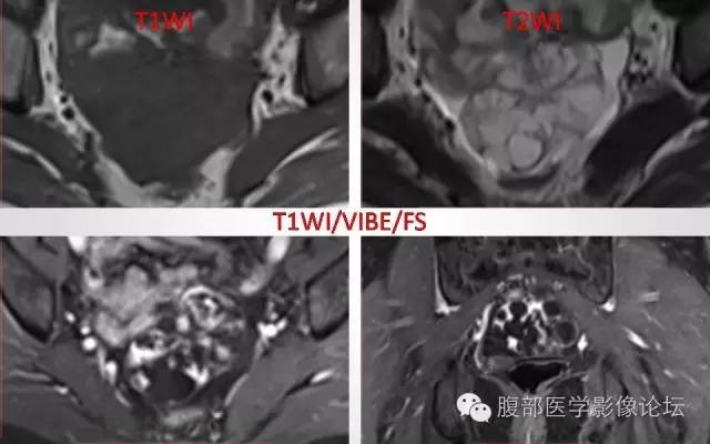 【病例】卵巢甲状腺肿1例CT及MR影像表现
