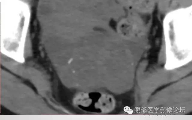 【病例】卵巢甲状腺肿1例CT及MR影像表现