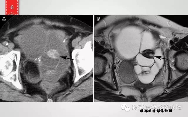 【病例】卵巢甲状腺肿1例CT及MR影像表现