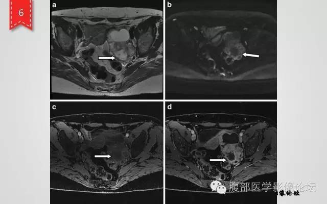 【病例】卵巢甲状腺肿1例CT及MR影像表现