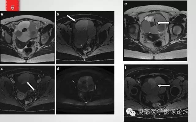【病例】卵巢甲状腺肿1例CT及MR影像表现