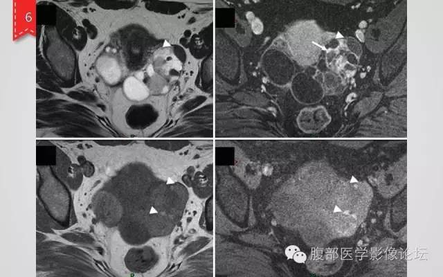 【病例】卵巢甲状腺肿1例CT及MR影像表现