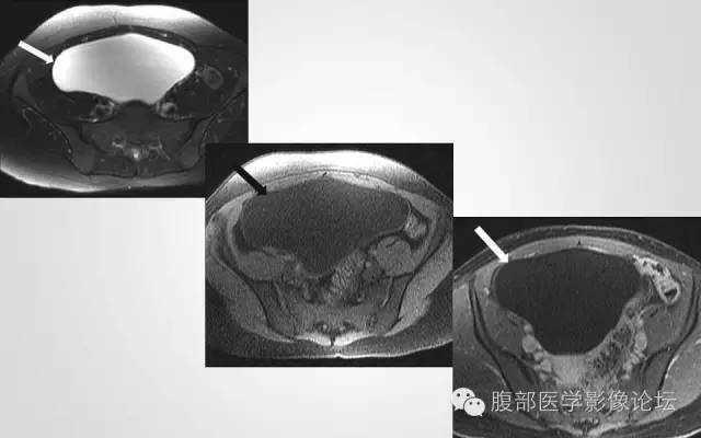 【病例】卵巢甲状腺肿1例CT及MR影像表现
