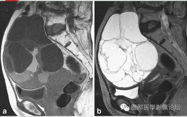 【病例】卵巢甲状腺肿1例CT及MR影像表现