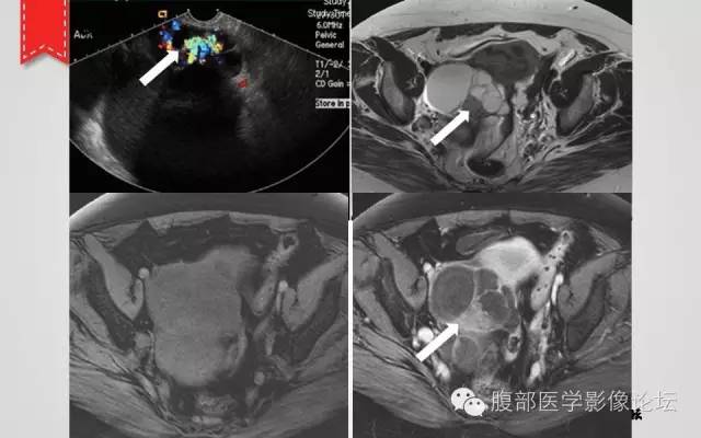 【病例】卵巢甲状腺肿1例CT及MR影像表现