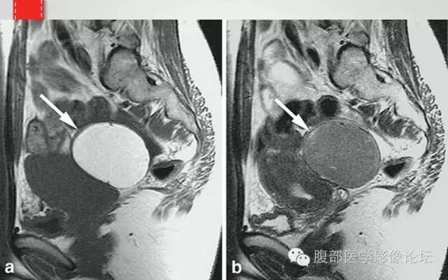 【病例】卵巢甲状腺肿1例CT及MR影像表现