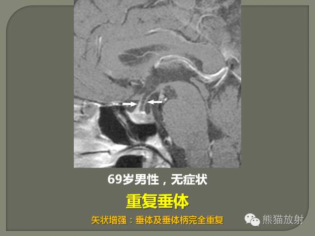 【PPT】垂体柄解剖及病变