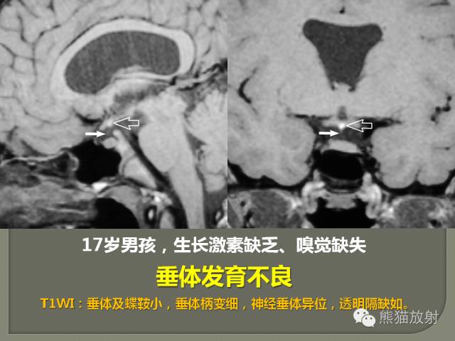 【PPT】垂体柄解剖及病变