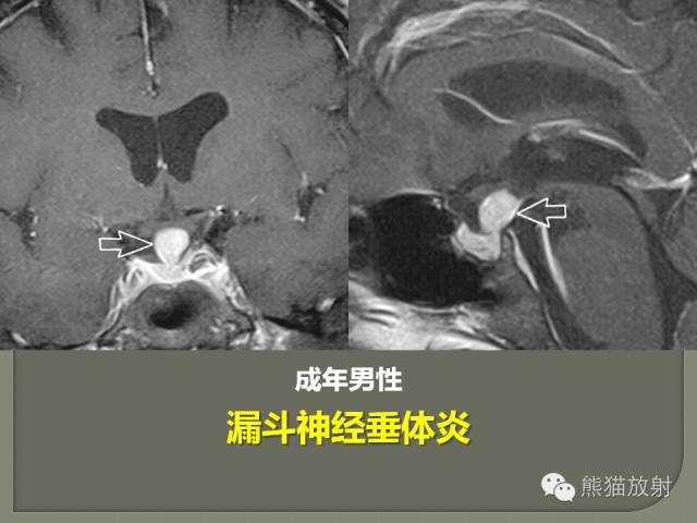 【PPT】垂体柄解剖及病变