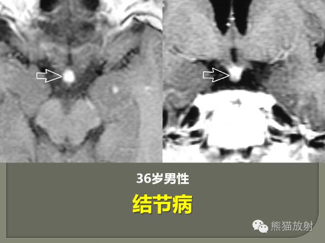【PPT】垂体柄解剖及病变