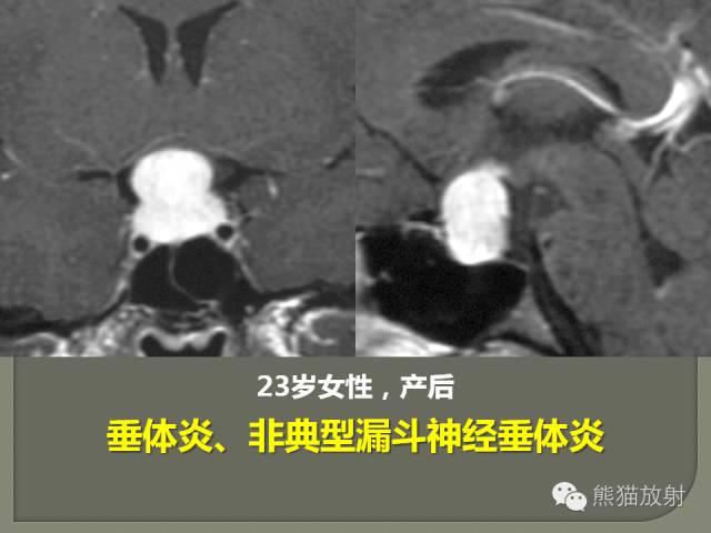 【PPT】垂体柄解剖及病变