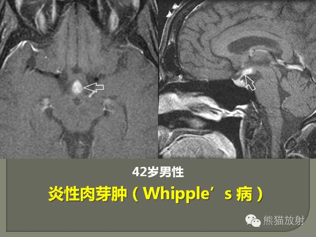 【PPT】垂体柄解剖及病变