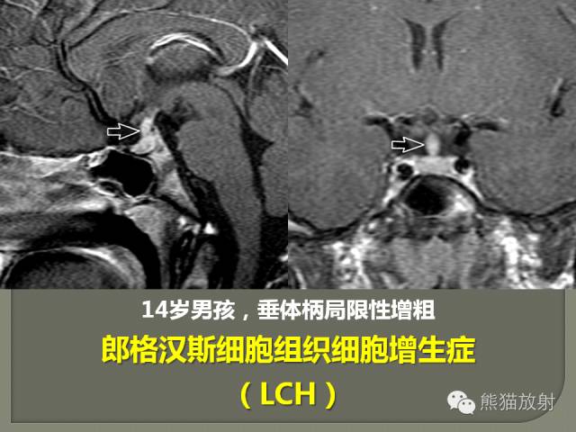 【PPT】垂体柄解剖及病变