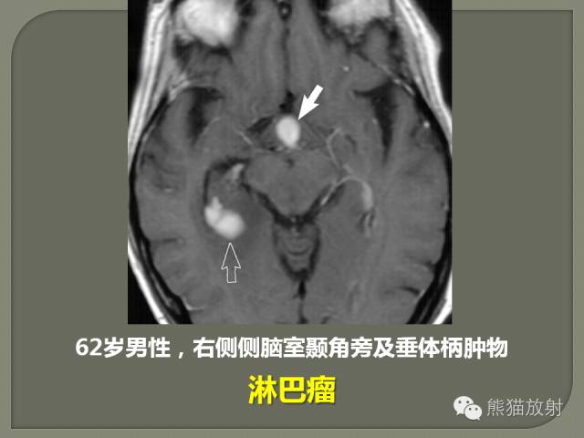 【PPT】垂体柄解剖及病变