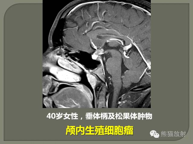 【PPT】垂体柄解剖及病变
