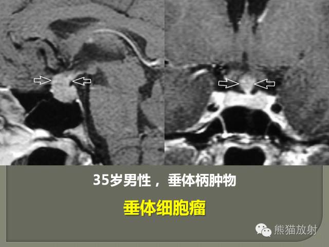 【PPT】垂体柄解剖及病变