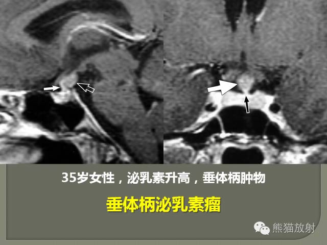 【PPT】垂体柄解剖及病变