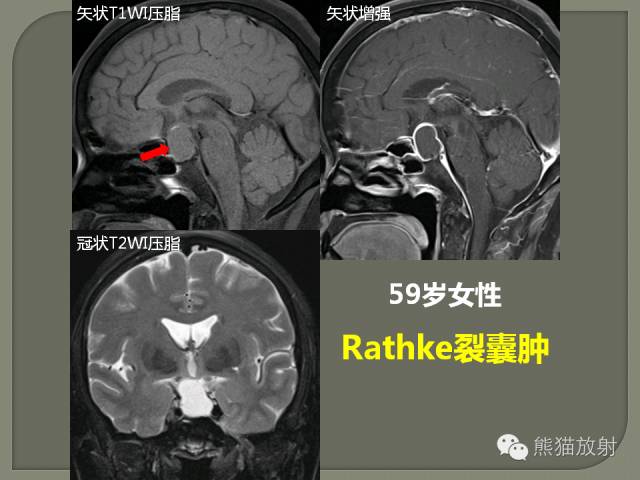 【PPT】垂体柄解剖及病变