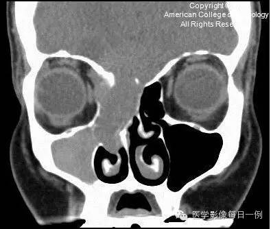 【病例】嗅神经母细胞瘤1例CT及MR影像表现 【病例】嗅神经母细胞瘤1例CT及MR影像表现