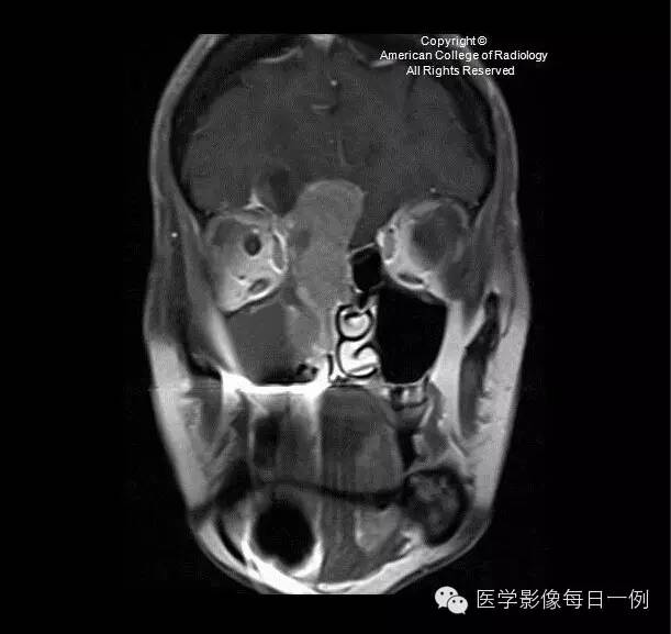 【病例】嗅神经母细胞瘤1例CT及MR影像表现 【病例】嗅神经母细胞瘤1例CT及MR影像表现