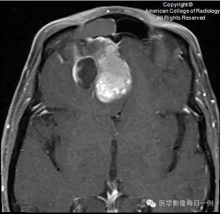 【病例】嗅神经母细胞瘤1例CT及MR影像表现 【病例】嗅神经母细胞瘤1例CT及MR影像表现