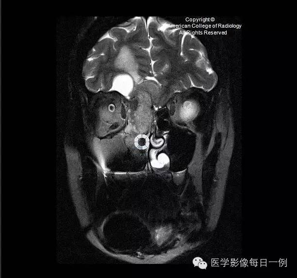 【病例】嗅神经母细胞瘤1例CT及MR影像表现 【病例】嗅神经母细胞瘤1例CT及MR影像表现