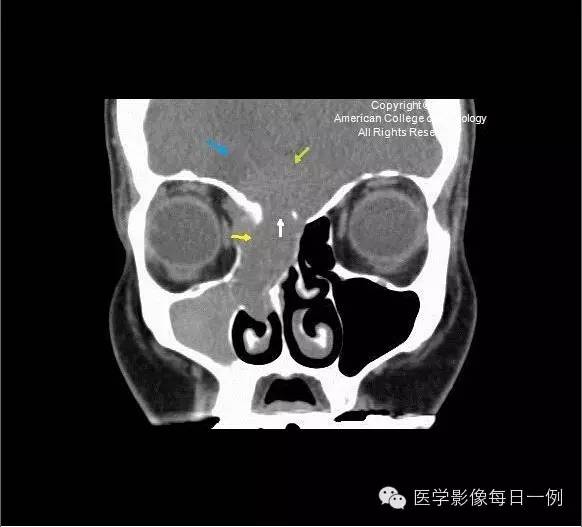 【病例】嗅神经母细胞瘤1例CT及MR影像表现 【病例】嗅神经母细胞瘤1例CT及MR影像表现