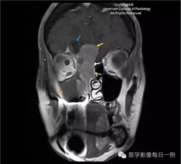 【病例】嗅神经母细胞瘤1例CT及MR影像表现