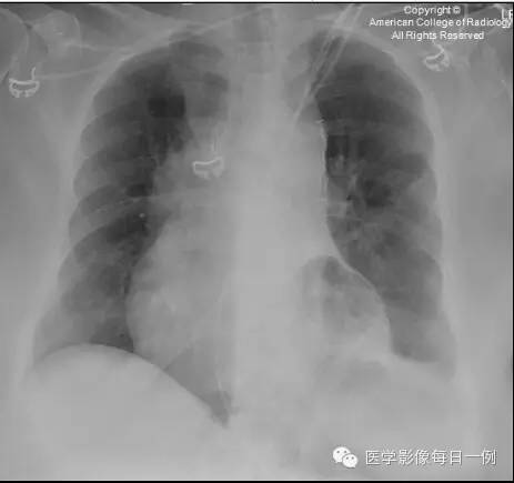【病例】横结肠疝入心包继发心包填塞1例X线及CT 【病例】横结肠疝入心包继发心包填塞1例X线及CT