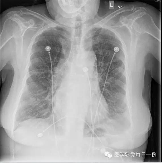 【病例】横结肠疝入心包继发心包填塞1例X线及CT 【病例】横结肠疝入心包继发心包填塞1例X线及CT