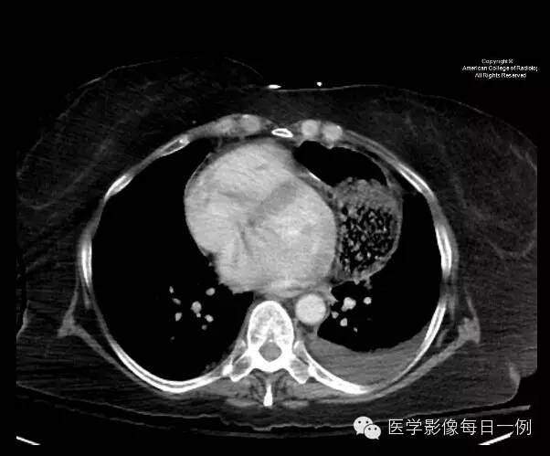 【病例】横结肠疝入心包继发心包填塞1例X线及CT 【病例】横结肠疝入心包继发心包填塞1例X线及CT