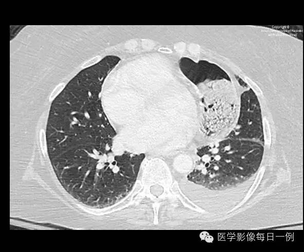 【病例】横结肠疝入心包继发心包填塞1例X线及CT 【病例】横结肠疝入心包继发心包填塞1例X线及CT
