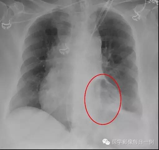 【病例】横结肠疝入心包继发心包填塞1例X线及CT 【病例】横结肠疝入心包继发心包填塞1例X线及CT
